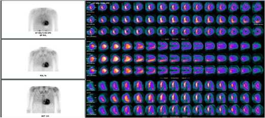 Scintigraphy with single photon emission computed tomography (SPECT) shows markedly increased tracer uptake in the area of both atria and ventricles with septal emphasis.