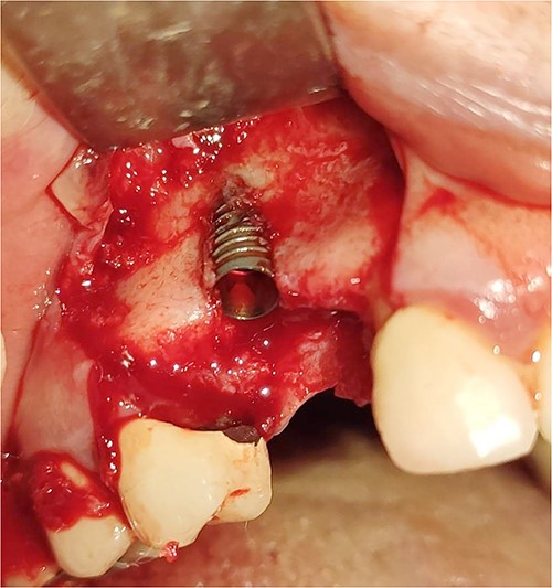 Inserting a dental implant of 3.5 mm diameter and 10 mm length into its prepared bed. The implant was completely surrounded by bone in its apical third only.