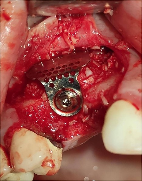 Reconstruction of the buccal plate using an allogeneic bone graft material and a prefabricated L-shaped titanium mesh. The titanium mesh was fixed to the implant with a cover screw.
