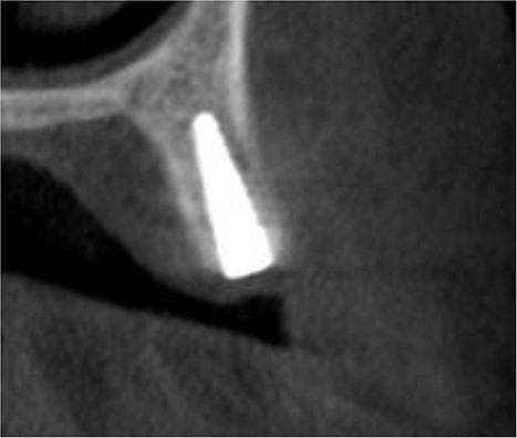 A CBCT scan 6 months after surgery showed formation of new bone buccally, and the entire dental implant being surrounded by bone.