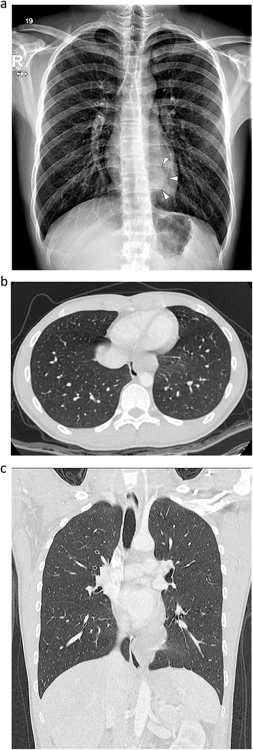 Radiographs of an 18-year-old man. (a) Simple radiograph shows a tumor in the left lower paravertebral area (arrow head). (b, c) A contrast-enhanced computed tomography scan. A 60 × 36 mm well-defined lobulated cystic mass in the left posterior mediastinum, abutting the esophagus.