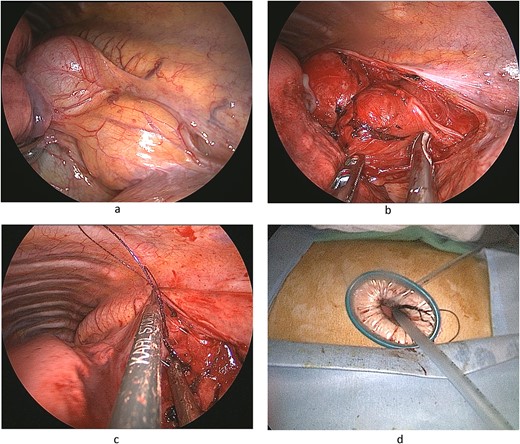 Operative findings. (a) Cystic tumor covered by mediastinal pleura located posterior mediastinum. (b) Distal half of the tumor was buried in muscular layer of esophagus. Left vagus nerve was placed beside the lower part of the tumor. (c) Continuous suturing of the esophageal muscular layer and periesophageal tissue using a barbed suture (V-Loc™ 90, Medtronic). (d) A 24 Fr drainage tube is inserted through 4-cm single port.