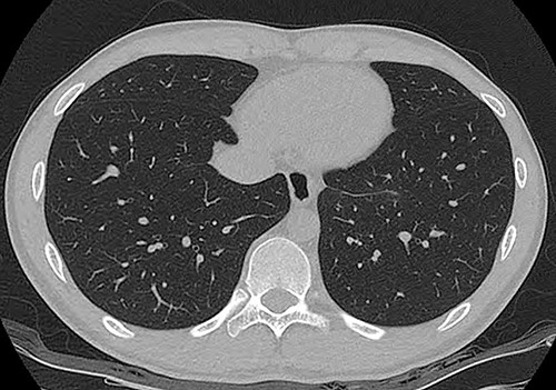 A computed tomography scan at 2 years 7 months after surgery. There was no evidence of tumor recurrence.