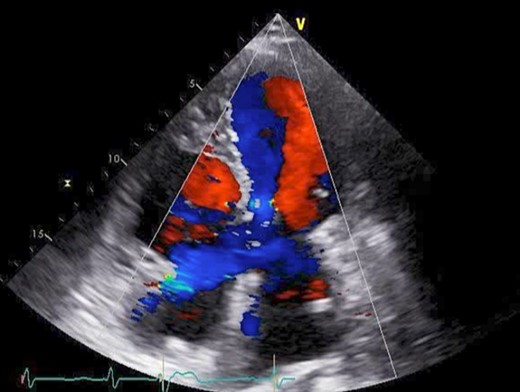 Preoperative cardio echography showing fraction EF 65%, MR severe, mean PAP 32 mmHg, left-to-right shunt flow, LVDd 48 mm, LVDs 32 mm, and a cleft mitral valve.