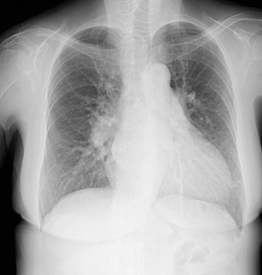 Chest X-ray showing a CTR of 58% and CPA sharp.