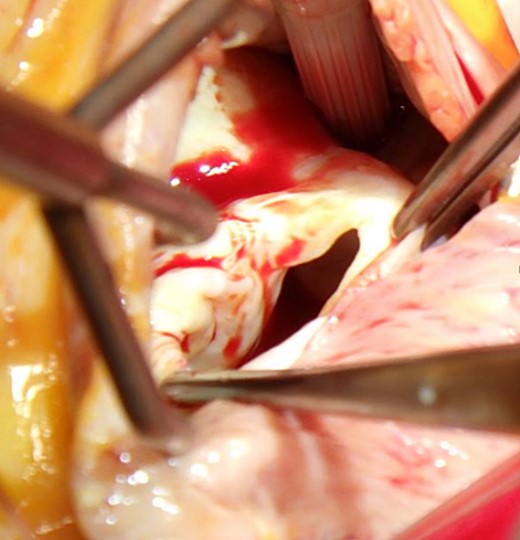 Ostium primum defect observed from the right atrium side.