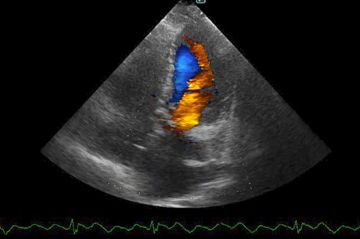 Postoperative cardio echography showing an EF of 64%, trivial MR, mean PAP of 18 mmHg, and no shunt flow.