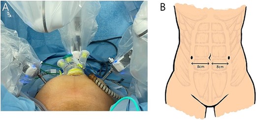 (A) The surgical setting of a 3PRM. (B) An anatomical illustration of 8-mm trocar sites in 3PRM.