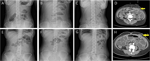 (A) Case 1: abdomen X-ray on POD #1; prominent small bowel gas with air-fluid level. (B) POD #4: aggravated ileus. (C) POD #7 after robotic myomectomy (POD #3 after exploration): recovered to a nonspecific normal gas pattern. (D) Small bowel herniation (arrow) is noticed at the left mid-axillary trocar site on a CT scan. (E) Case 2: abdomen X-ray on POD #3; mild ileus with air-fluid level (F) POD#6 on the morning of surgery: persistent ileus with L-tube in situ. (G) POD #9 after robotic myomectomy (POD #3 after exploration): nonspecific bowel gas shadow. (H) Small bowel herniation (arrow) is noticed at the left mid-axillary trocar site on a CT scan.
