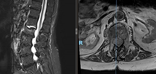 Preoperative lateral (left) and axial (right) MRI of the patient’s spine showing L2 compression fracture.