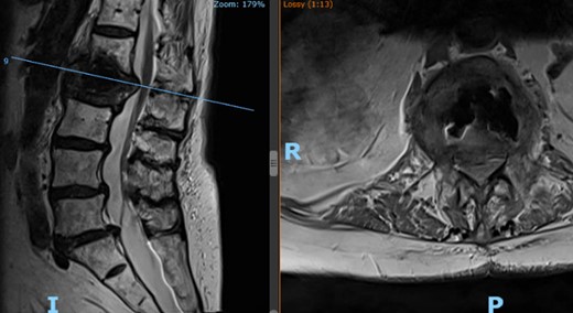 Patient’s lateral (left) and axial (right) MRI following the kyphoplasty procedure, demonstrating L1 fracture with retropulsion and compression of the conus.