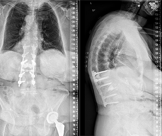 Anterior–posterior and lateral radiographs of the patient’s spine postoperatively, following L1-L2 laminectomy and T11-L4 posterior fusion.