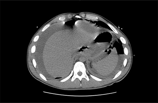 Non-contrast CT abdomen/pelvis in axial view demonstrating diffuse intra-abdominal free fluid with multiple large locules of intraperitoneal free air.