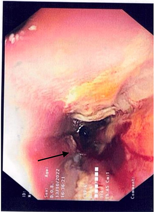 Gastroscopic image demonstrating the pinhole defect of the GOJ at the 9 o’clock position (arrow).