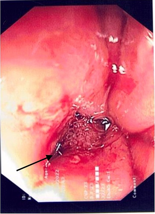 Gastroscopic image demonstrating the successful application of haemostatic clips at the site of perforation (arrow).