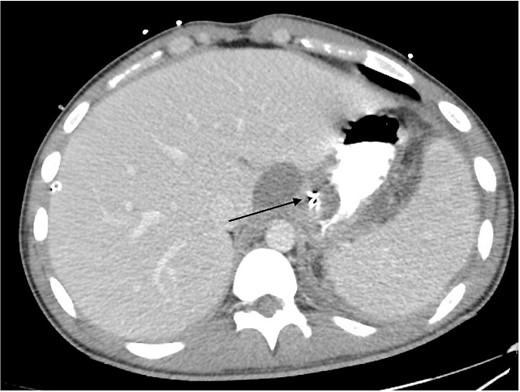 Intravenous and oral contrast enhanced CT abdomen/pelvis on post-operative Day 5, in axial view, demonstrating the placement of haemostatic clips at the previous site of perforation (arrow), with no evidence of ongoing leak.