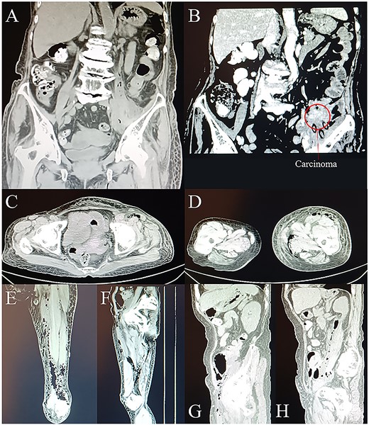CT scans on day 1. (A) and (B) Coronal planes from CT display abdominal gas formation, abscess and tumor around descending colon. Tumor locates in the left lower abdomen. (C) Transverse, (E) coronal, and (G) sagittal planes from CT display gas extending to and going through the groin area. (D) Transverse and (F) coronal planes from CT display the downward route of gas formation. (H) Sagittal plane from CT displays the involvement of iliopsoas muscle.