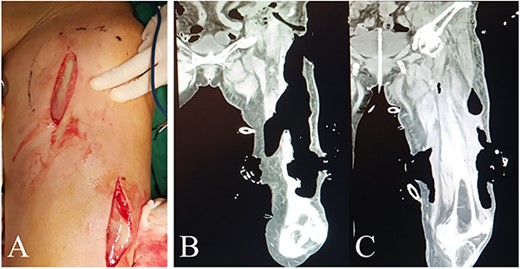 Intraoperative view and postoperative CT of left thigh in the first operation. (A) Intraoperative anterior view of left thigh. (B) and (C) Coronal planes from CT 7 days after the first operation display areas dressed with VSD (PU) material.
