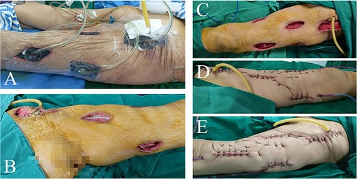 Intraoperative view of left thigh in the second and third operation. Lateral view of left thigh before (A) and after (B) removing VSD (PU) material in the second operation. (C) Anterior view of left thigh after removing VSD (PU) material in the third operation. (D) Interior and (E) lateral view of repaired left thigh.