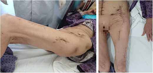 Recovery 11 months after treatment (day 332).