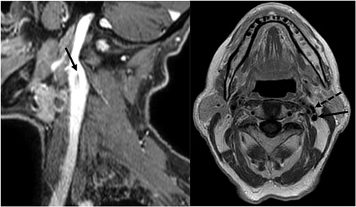 MRI showing the fenestration of the IJV; left image: sagittal section showing the fenestration (arrowhead) of the left IJV; right image: axial section showing the anterior (dotted arrowhead) and the posterior (arrowhead) part of the fenestrated IJV.