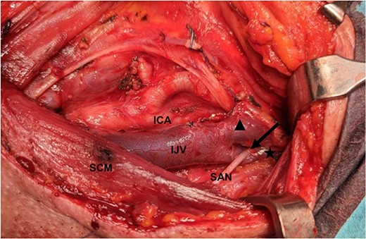 SAN passes through medially to the anterior part (filled triangle) and laterally to the posterior part (star) of the fenestrated IJV (arrowhead); ICA: internal carotid artery; SCM: sternocleidomastoid muscle.