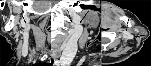 CT scan showing the fenestration of the IJV; left image: sagittal section showing the fenestration (arrowhead) of the left IJV; central image: coronal section showing the anterior (dotted arrowhead) and the posterior (arrowhead) part of the fenestrated IJV; right image: axial section showing the anterior (dotted arrowhead) and the posterior (arrowhead) part of the fenestrated IJV.