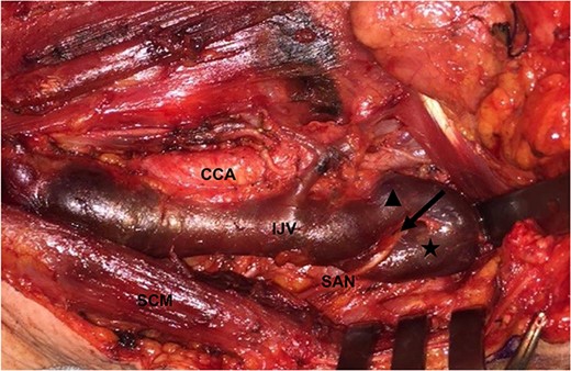 SAN passes through medially to the anterior part (filled triangle) and laterally to the posterior part (star) of the fenestrated IJV (arrowhead); CCA: common carotid artery.