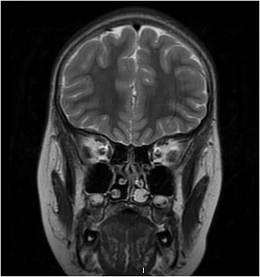 Pre-operative coronal T2-weighted brain MRI showing high signal intensity left-sided intra-nasal lesion.