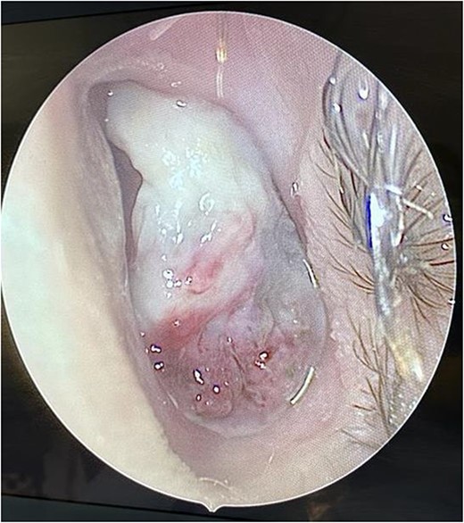 Intra-operative endoscopic findings of the left nasal cavity, showing a vascularized mass occupying the left nasal cavity.