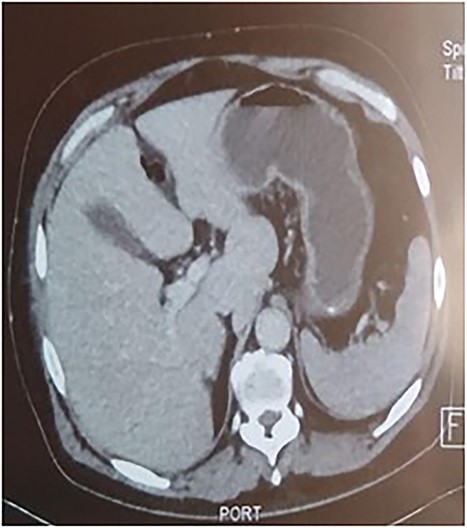Pneumoperitoneum.