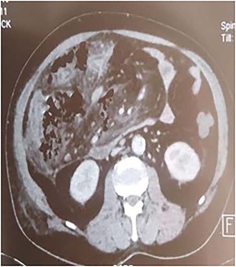 Pancreatic necrosis.