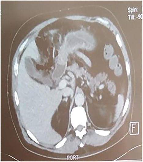 Thickening of the mesentery root.