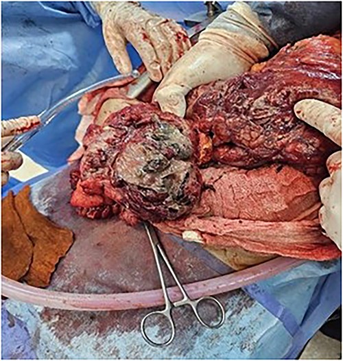 Omentum gangrene.