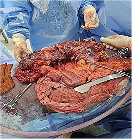 Right colon gangrene.