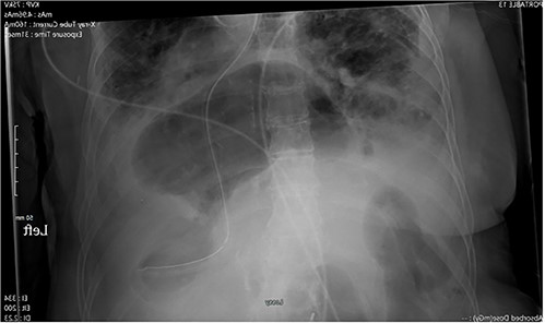 X-ray of the abdomen: anterior–posterior portable X-ray of the abdomen showing bowel gas pattern in the right upper abdomen and a large hiatal hernia with gaseous distention of the stomach.
