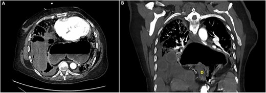 Computed tomography of the chest and abdomen: (A) axial section demonstrating incarcerated small bowel within the right hemithorax as well as stomach within the posterior mediastinum. (B) Coronal section demonstrating incarcerated small bowel within the right hemithorax above the liver as well as hiatal hernia containing stomach in an organoaxial rotation as well as the duodenum (D).