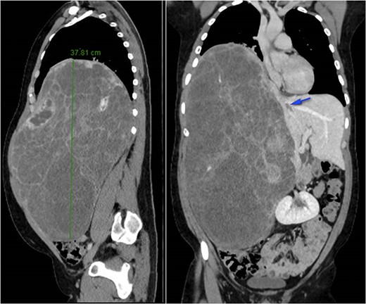 CT-scan at patient admission.