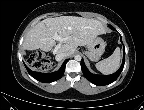 CT-scan 6 months after surgery.
