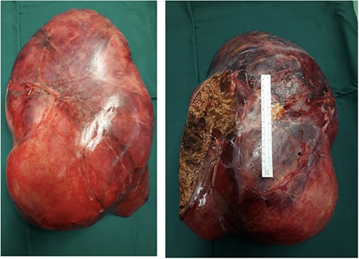 Right and left surface of the tumour. The ruler in the image in a standard 15 cm.