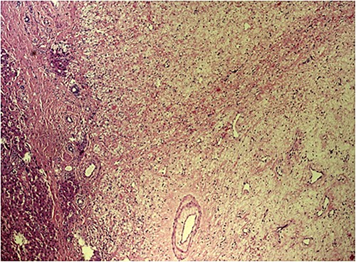 Microscopic aspect of the tumour.