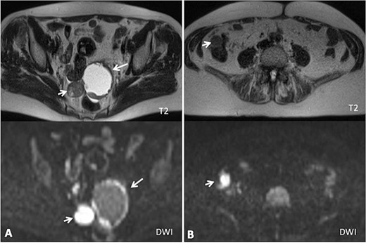 (A) Axial MRI imaging showing the pelvic tumor implants; (B) axial MRI imaging showing the implants in the right colon (diffusion weighted imaging).