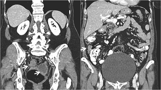Coronal CT imaging showing the pelvic tumor implants and in the right colon.