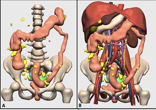 (A) 3D model of the tumor and carcinomatosis; the generated model includes the carcinomatosis (yellow), possible adenopathies (orange), cystic pelvic lesion (green), solid pelvic lesion (blue), rectum and colon (brown); (B) 3D model of the tumor, carcinomatosis, and anatomical structures; the generated model includes the carcinomatosis (yellow), arterial vessels (red) venous vessels (blue), portal vessels (purple), liver (dark brown), stomach and duodenum (white), biliary bladder (green), spleen (dark purple), pancreas (gray).