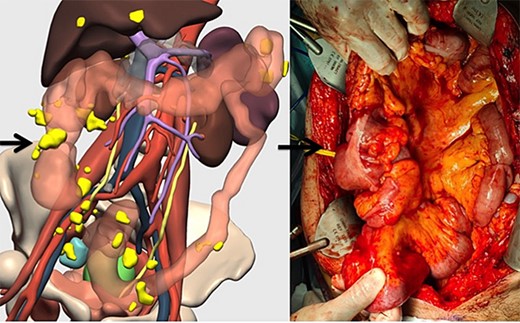 Correlation between the 3D model and surgical findings on the right colon and tumor implants (arrows).