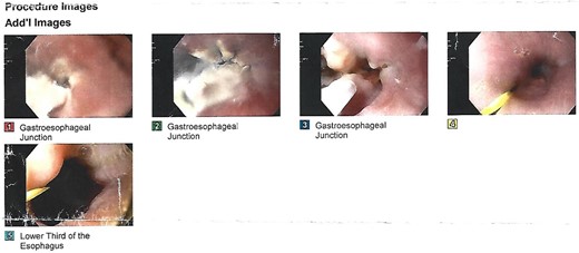 Upper digestive endoscopy.