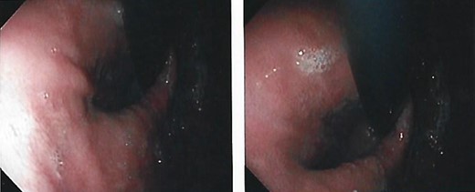 Upper digestive endoscopy with hiatal hernia.