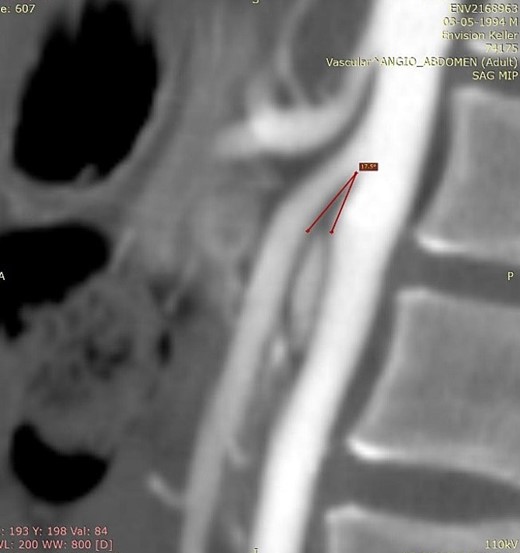 Computed tomography. Aortomesenteric angle of 17.5°.