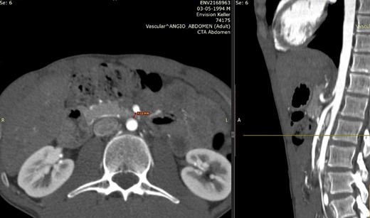 Computed tomography. Aortomesenteric distance of 4 mm. Wilkie’s syndrome.