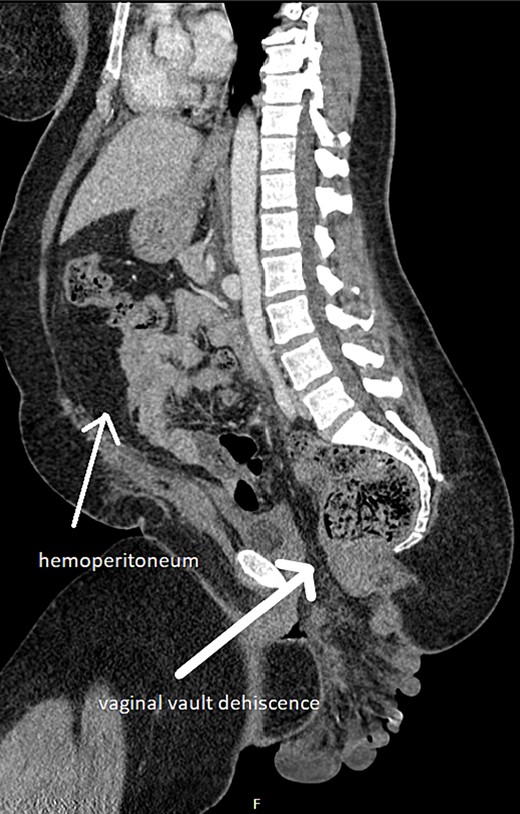 Small bowel evisceration through vaginal vault dehiscence and haemoperitoneum on CT.